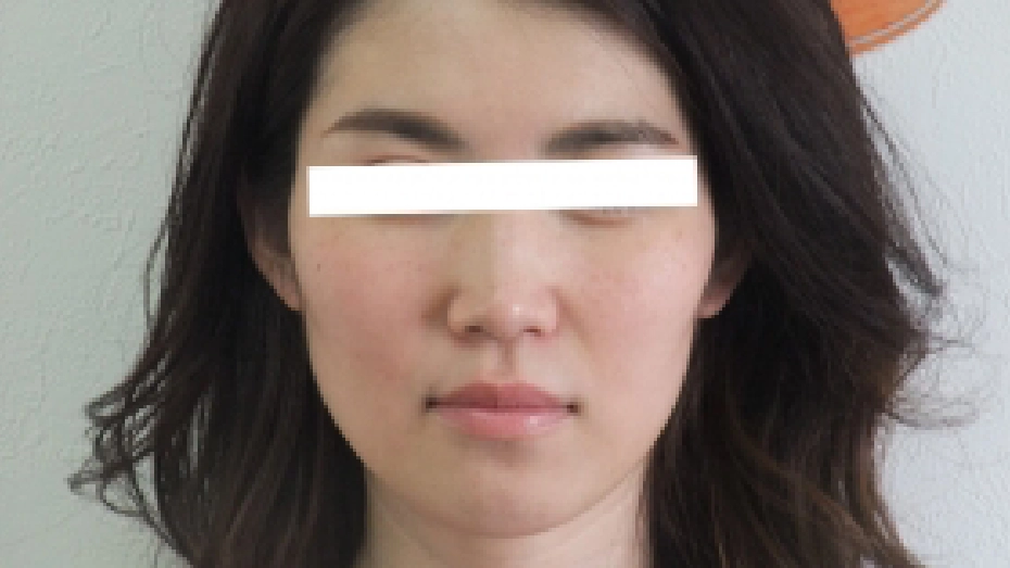 顔のむくみと小顔を希望された32歳女性の施術前写真