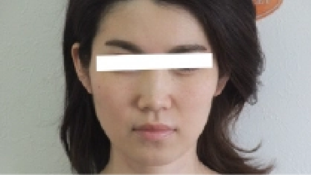 顔のむくみと小顔を希望された32歳女性の施術後写真
