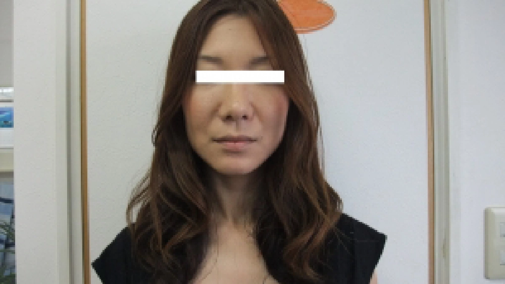 首の不調に対する施術前後で顔幅を計測した31歳女性の比較写真