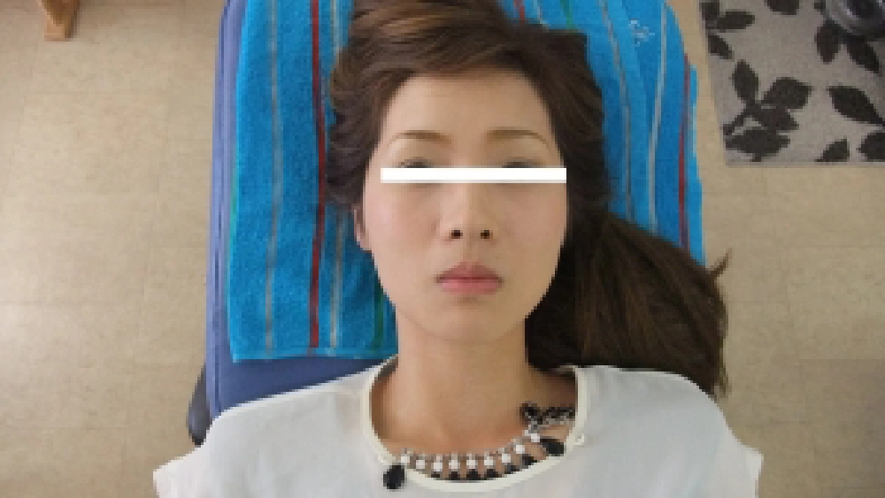 定期的なメンテナンスを受けている26歳女性の施術前写真