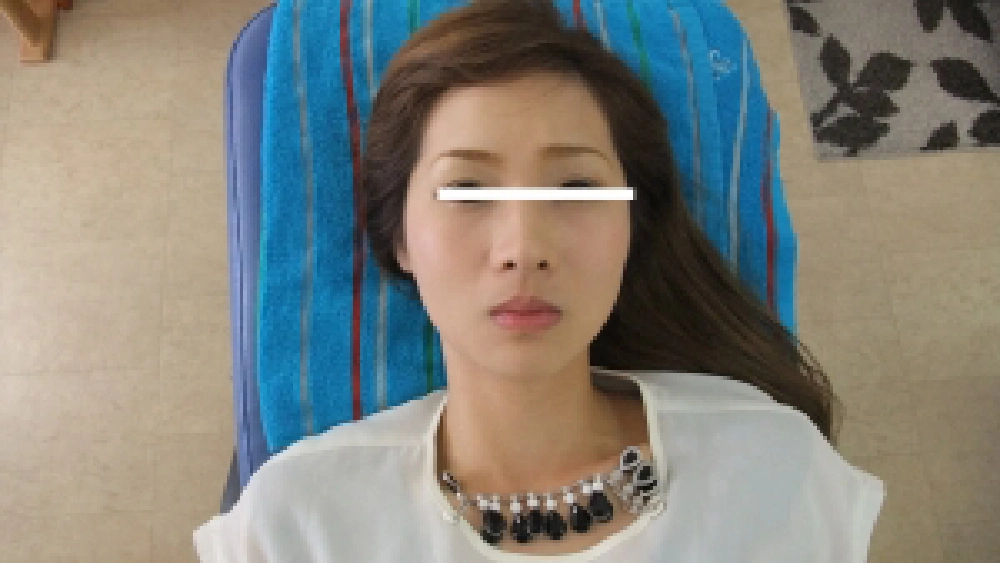 定期的なメンテナンスを受けている26歳女性の施術後写真