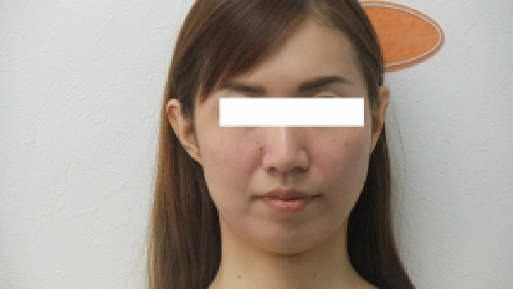 フェイシャルケアを希望された30歳女性の施術前写真