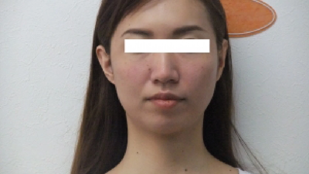 フェイシャルケアを希望された30歳女性の施術後写真