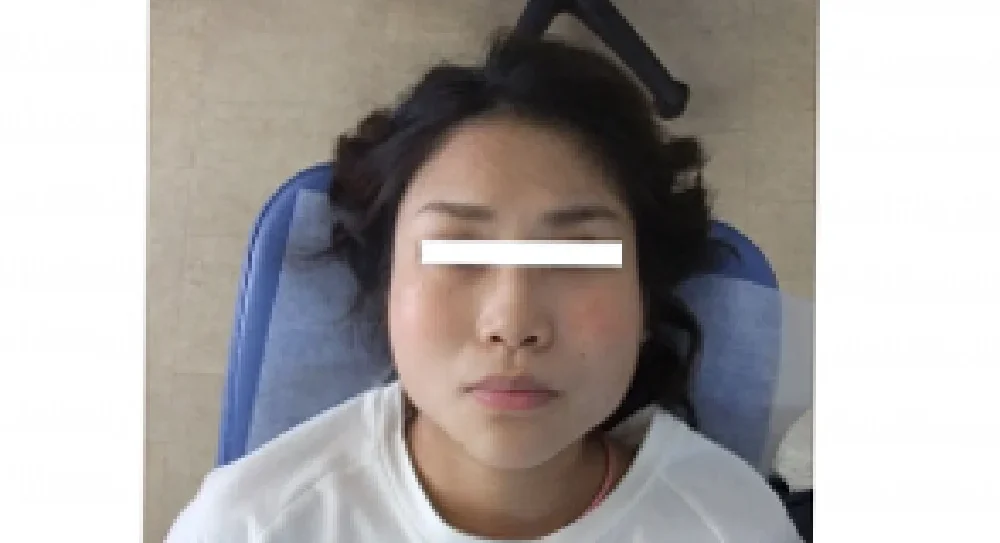 産後の身体ケアとあわせて顔幅を計測した24歳女性の施術前写真
