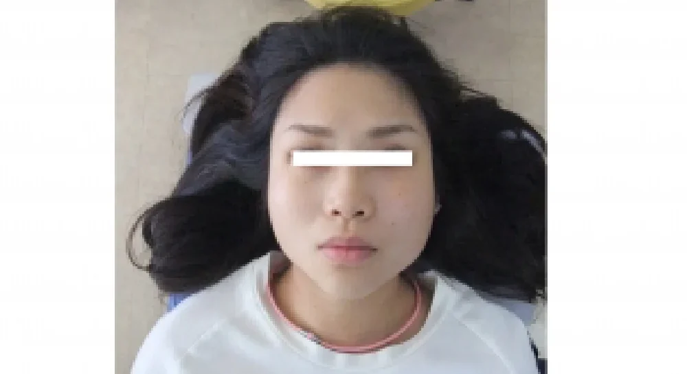 産後の身体ケアとあわせて顔幅を計測した24歳女性の施術後写真