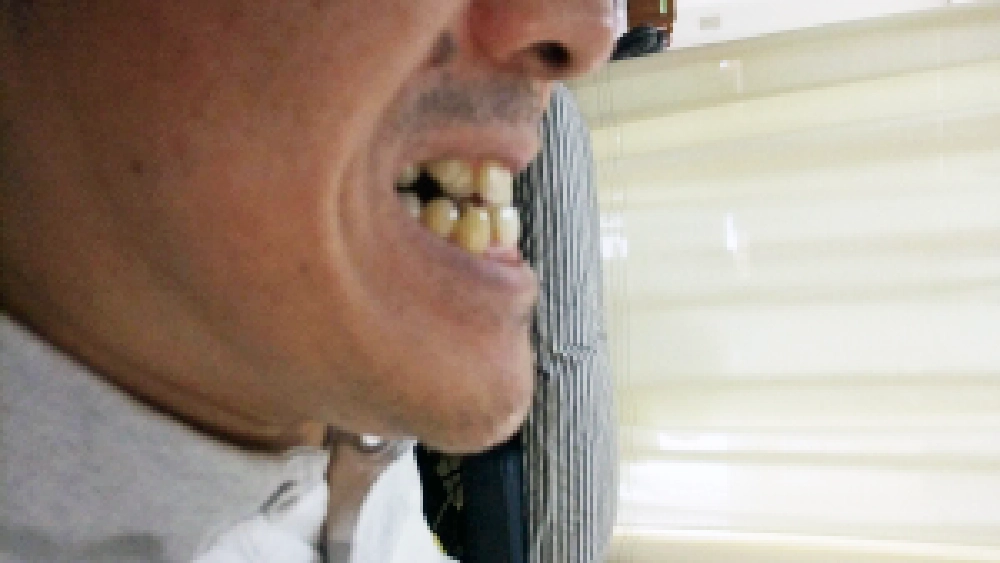 顎まわりのバランスについて相談された39歳男性の施術前写真